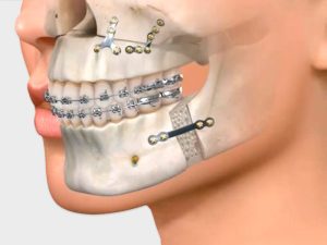 cirurgia buco-maxilo-facial