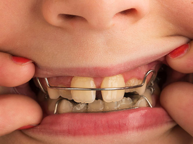 ortopedia funcional dos maxilares