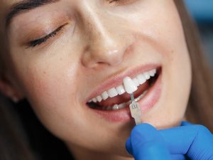 lente de contato dental